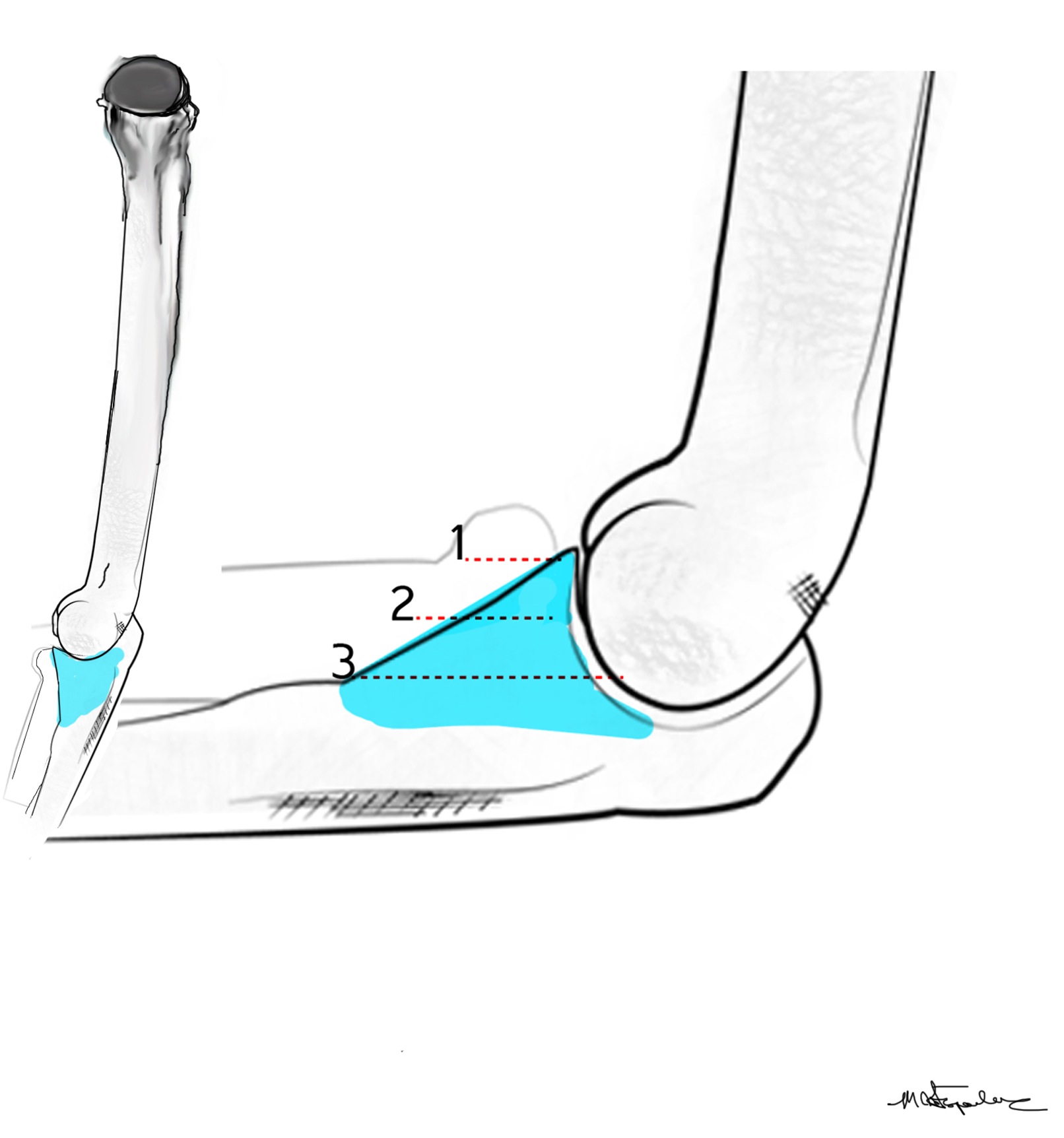 Classification Coronoid Fractures